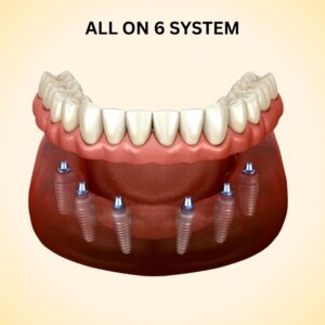 allon6 1
