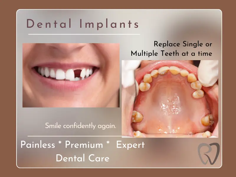 implants when