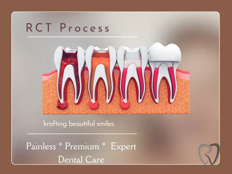 rct-process rct process
